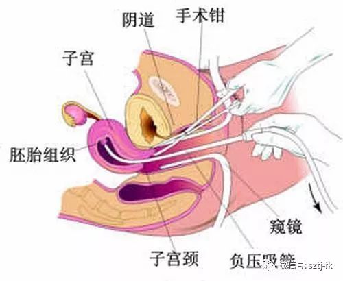 关于三个月妊娠人流是否需要住院的探讨