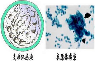 两个月胎停做什么流产，了解过程与选择